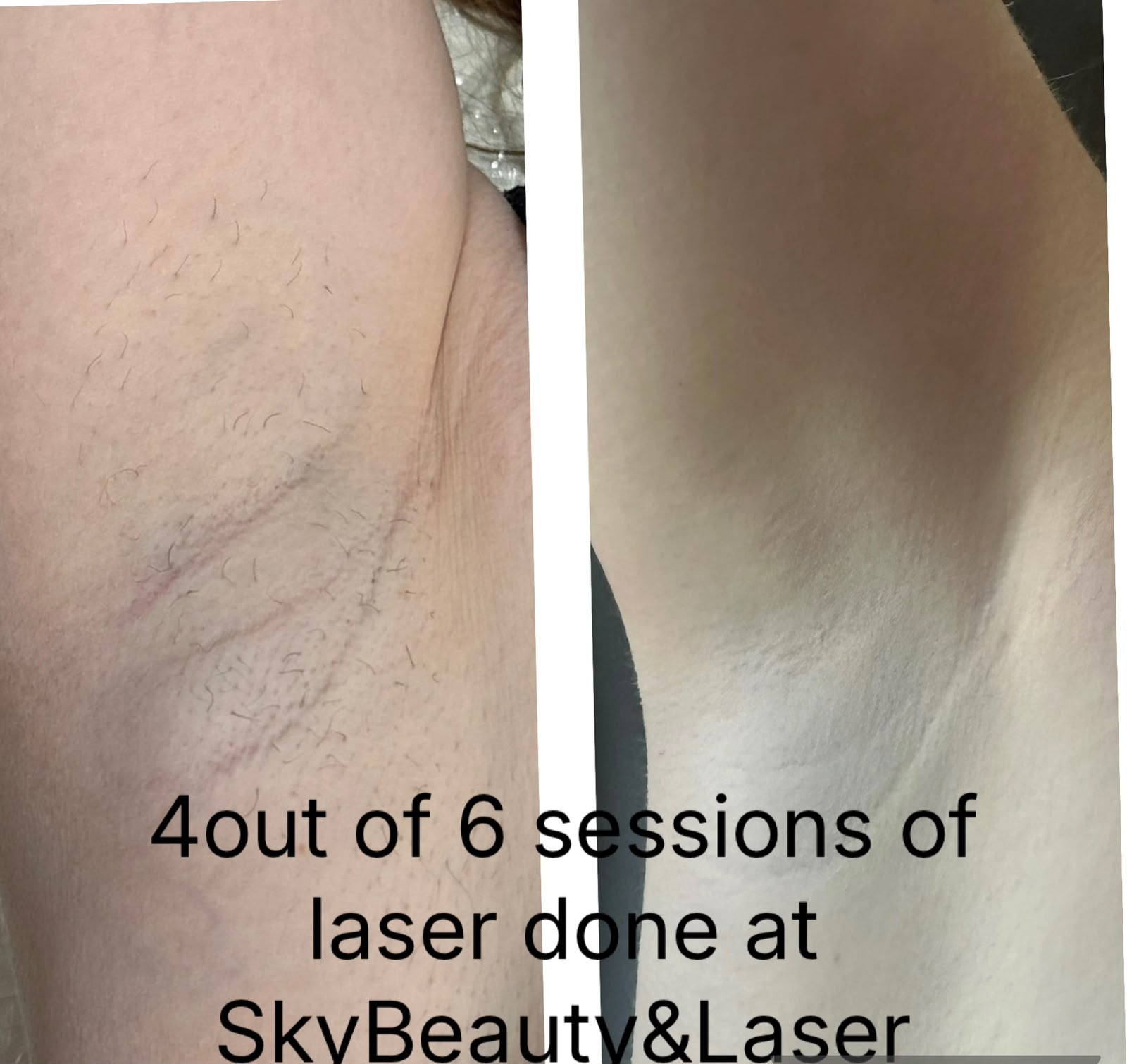 Before and after laser hair removal client result